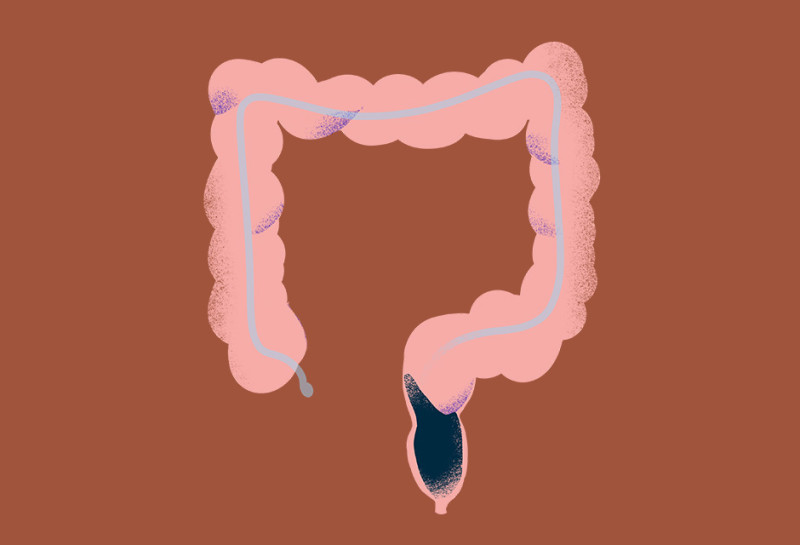 rectal cancer type illustration oc